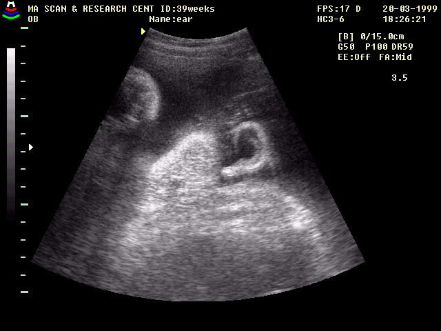 Fetal ear at 39 weeks gestational age