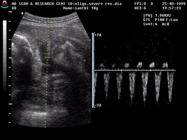 Reverse Dialistic Wave in Umbilical Artery.